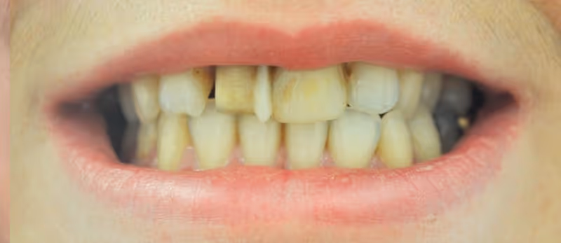 Before Treatment