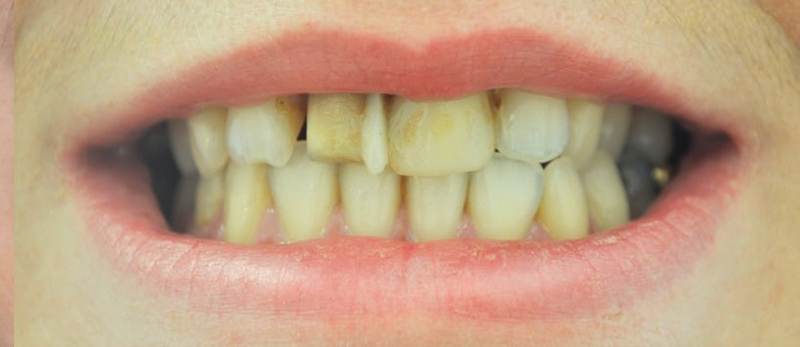 Before Treatment