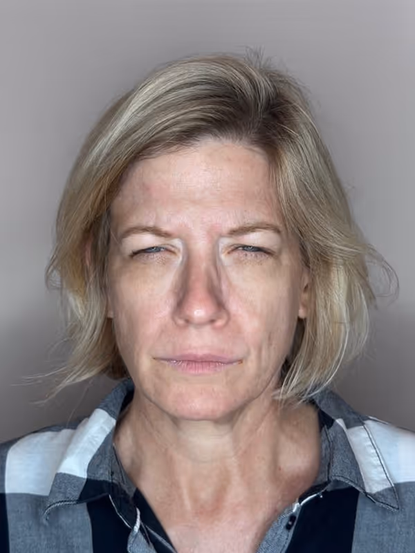 Before Treatment