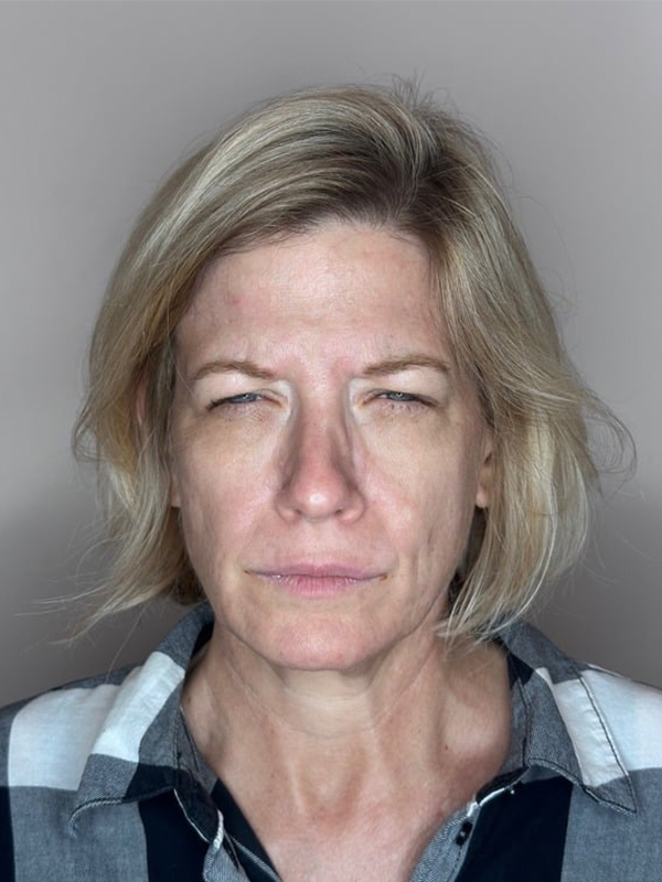 Before Treatment