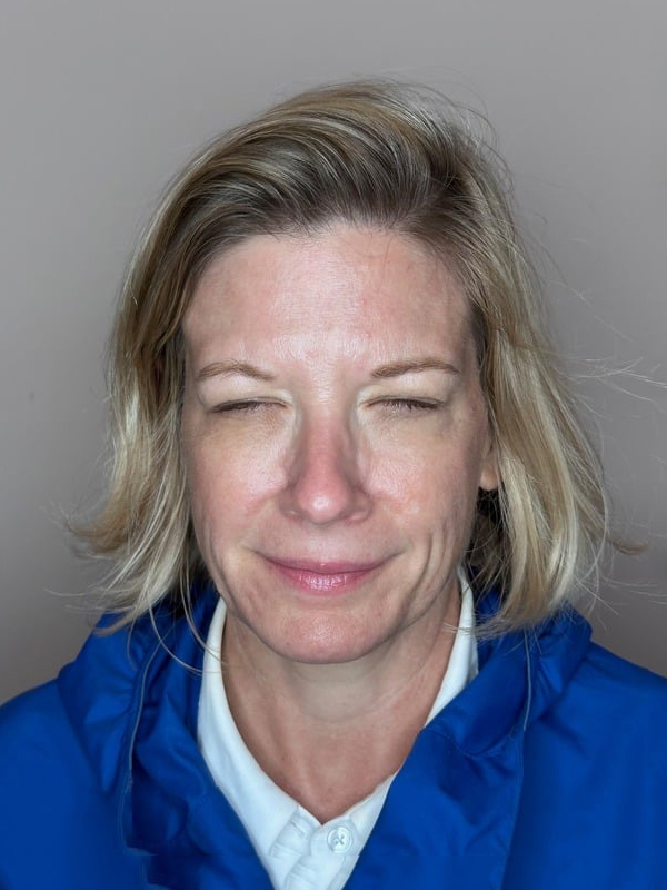 After Treatment