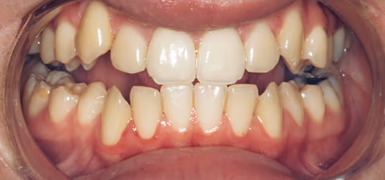 Before Treatment