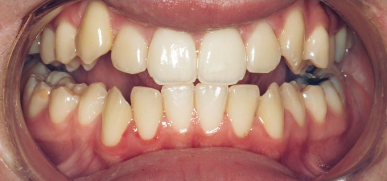 Before Treatment