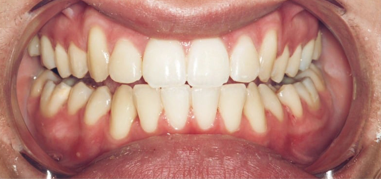 After Treatment