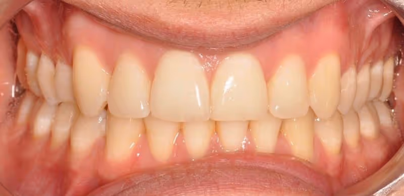 Before Treatment