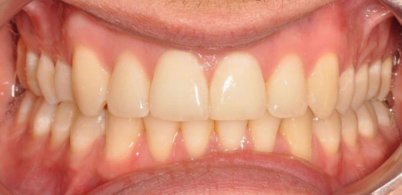 Before Treatment