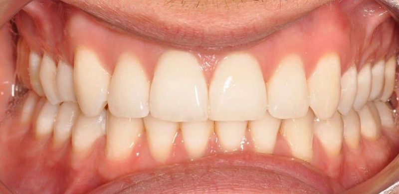 After Treatment