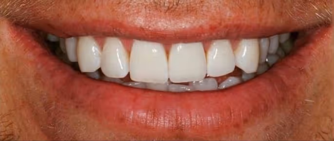 After Treatment