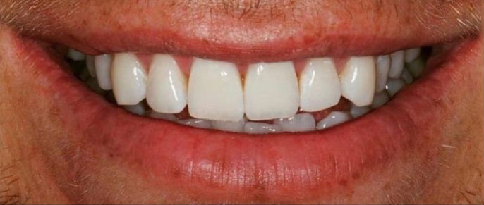 After Treatment