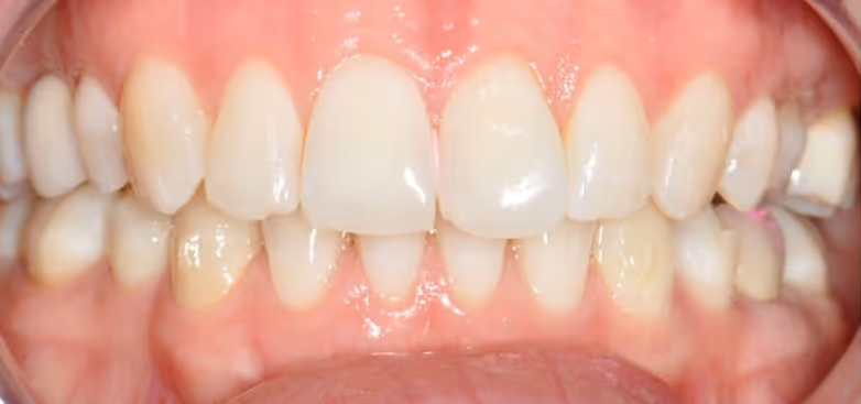 After Treatment