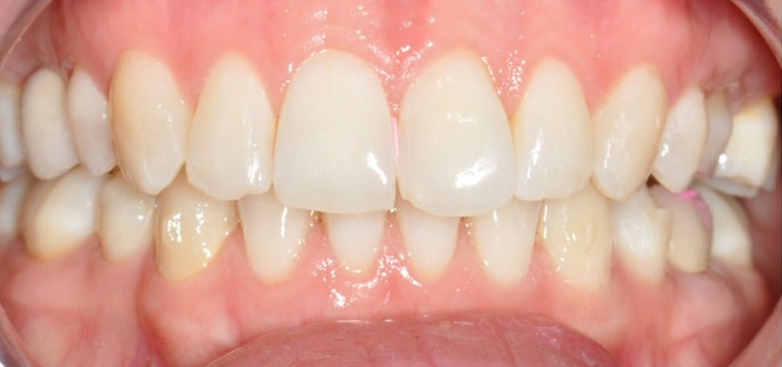 After Treatment