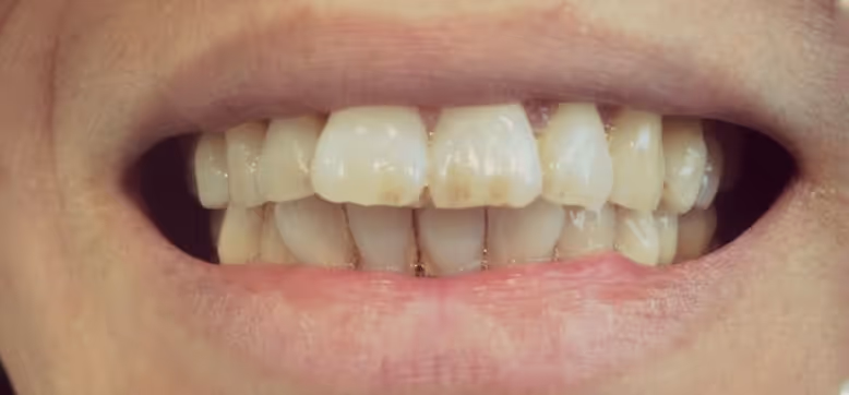 Before Treatment