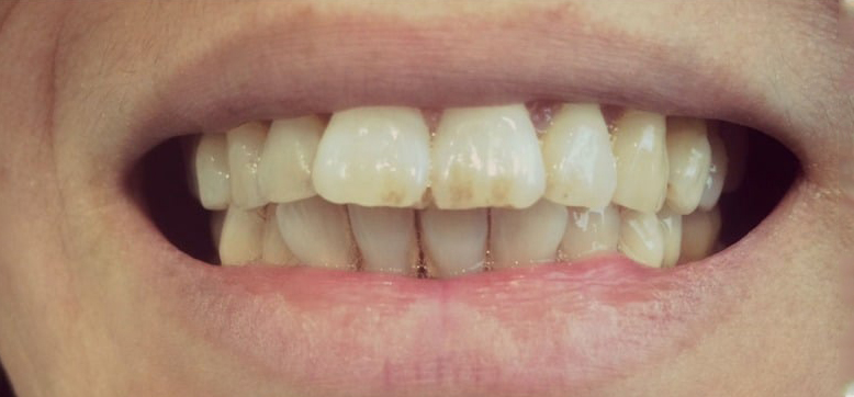 Before Treatment