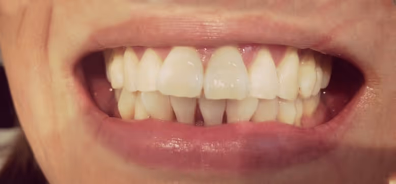 After Treatment