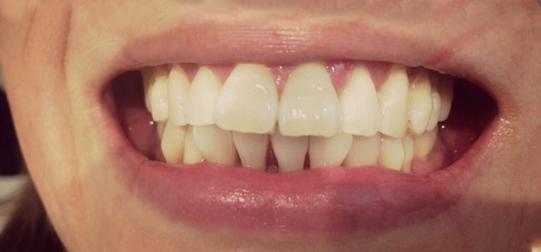 After Treatment