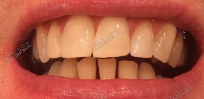 Before Treatment