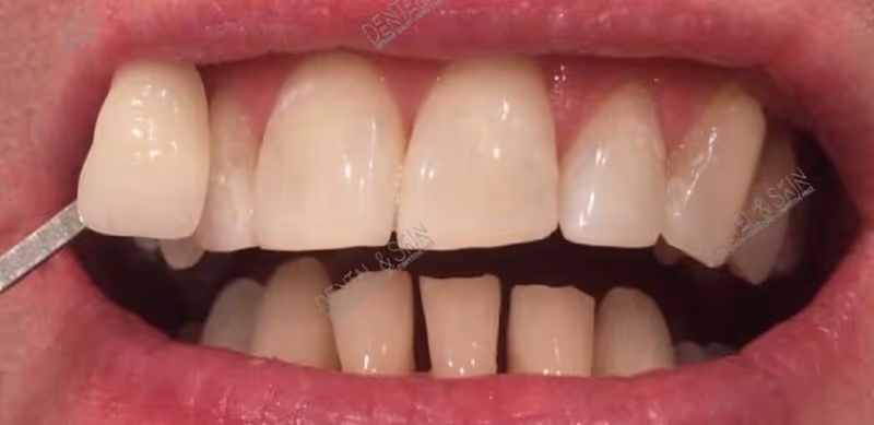 After Treatment