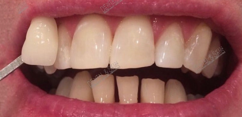 After Treatment