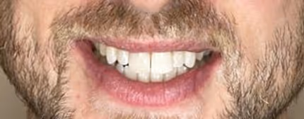 After Treatment