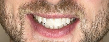 After Treatment