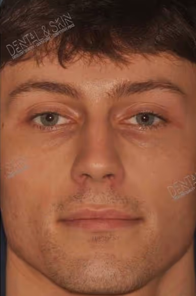 Before Treatment