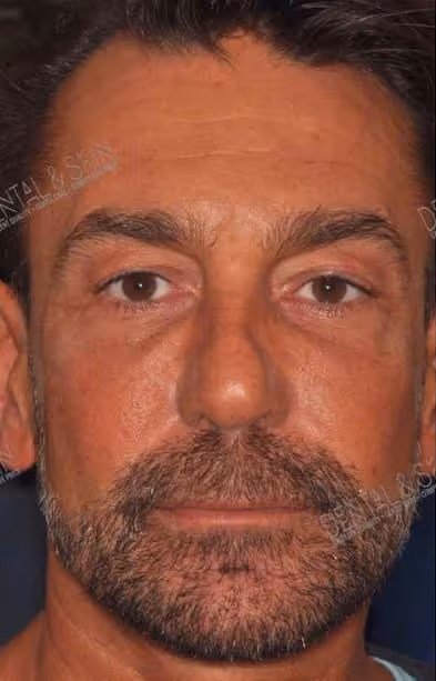 Before Treatment