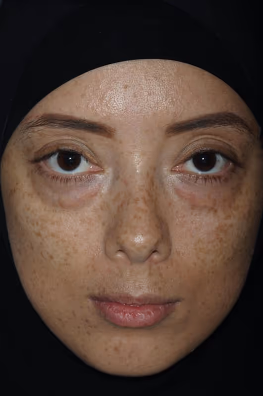 Before Treatment