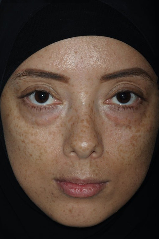 Before Treatment