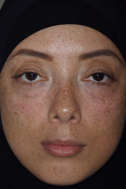 After Treatment