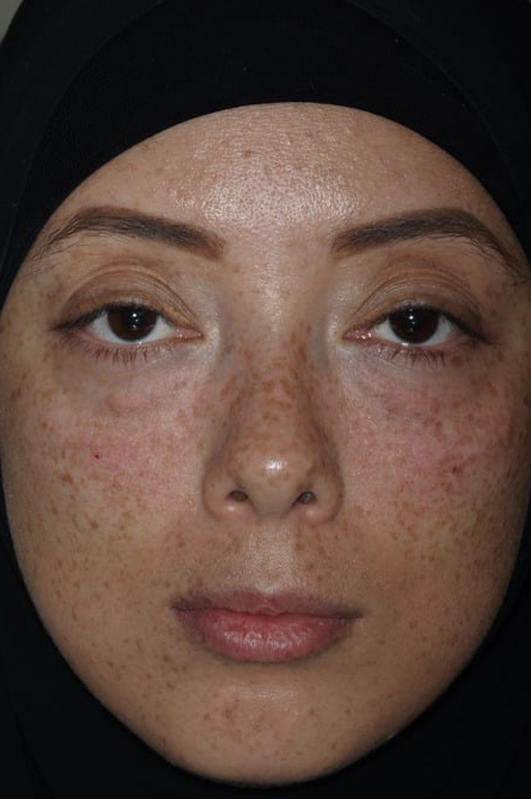 After Treatment