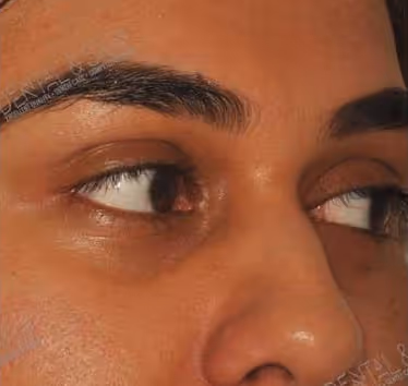 Before Treatment