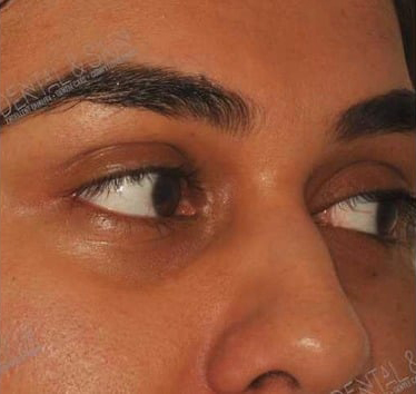 Before Treatment