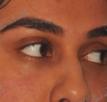 After Treatment