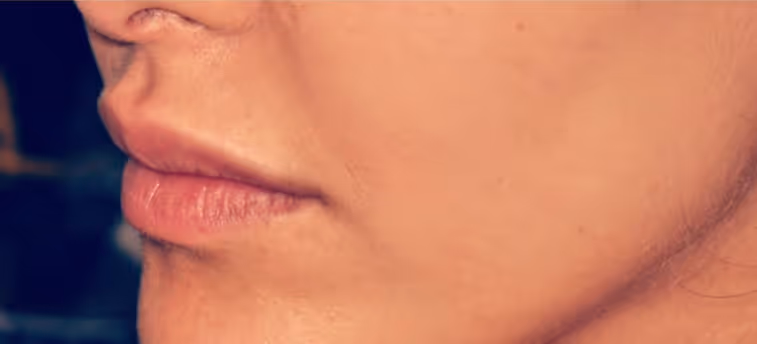 Before Treatment