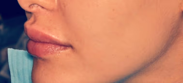 After Treatment