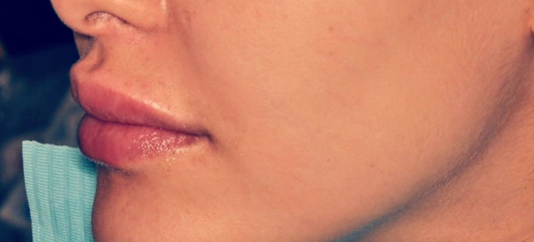 After Treatment