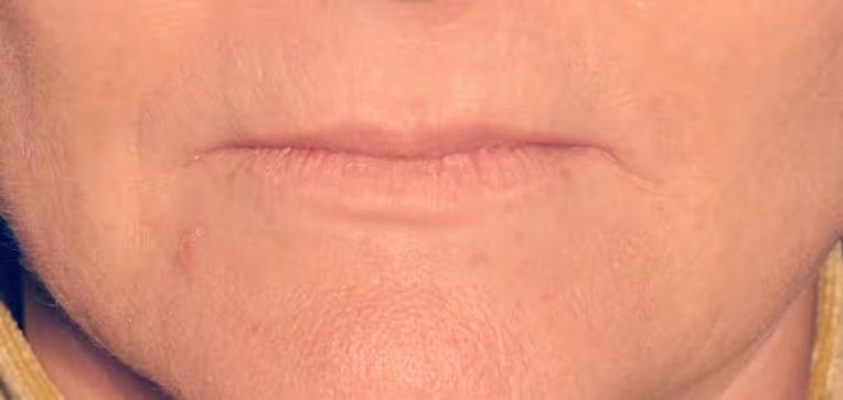 Before Treatment