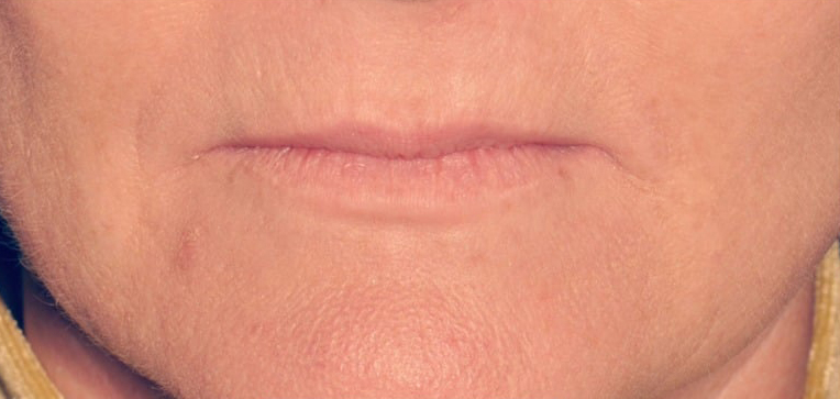 Before Treatment