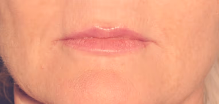 After Treatment