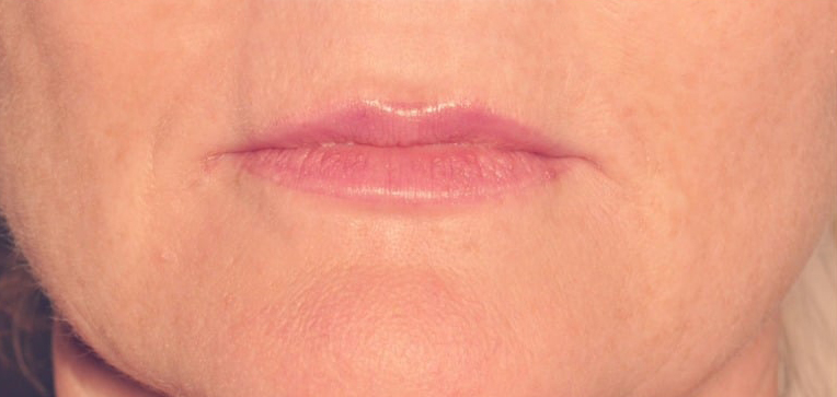 After Treatment