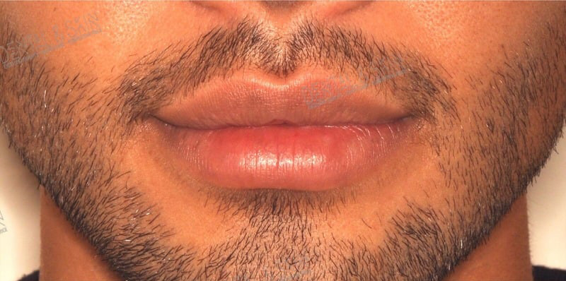 Before Treatment