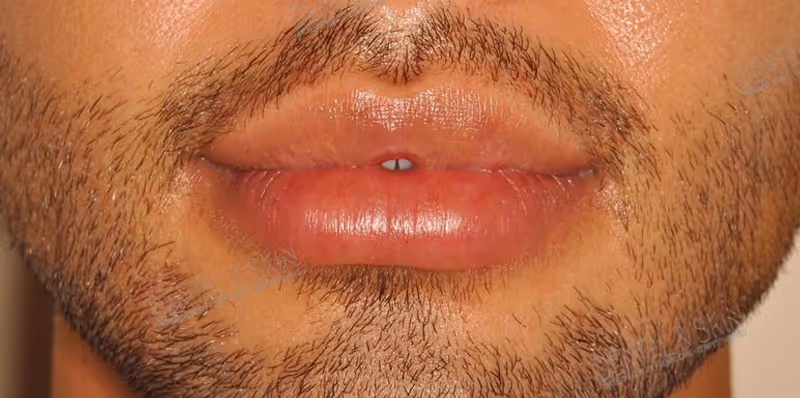 After Treatment