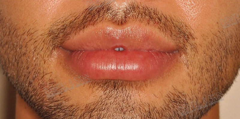After Treatment