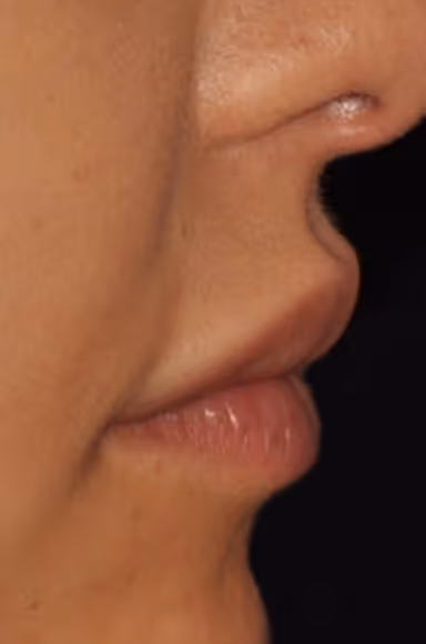 Before Treatment
