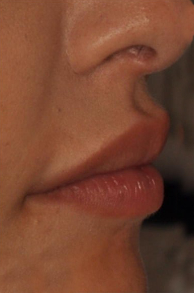 After Treatment