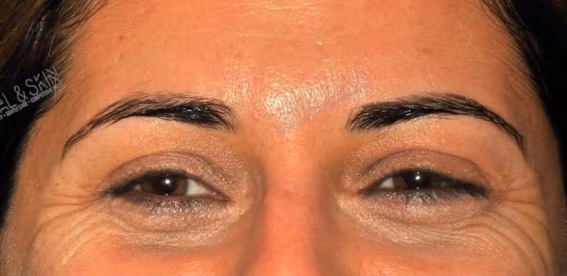 Before Treatment