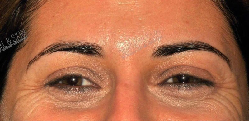 Before Treatment