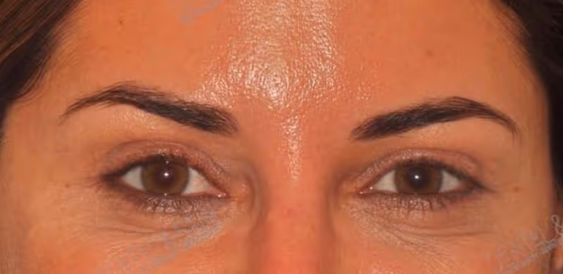 After Treatment