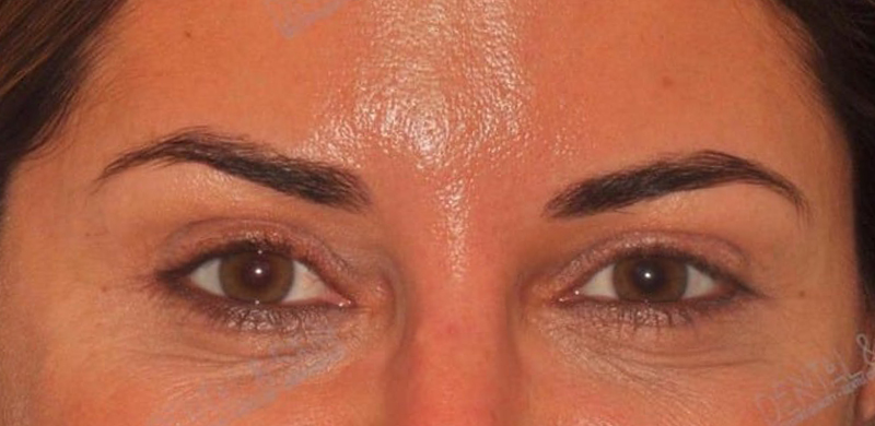 After Treatment