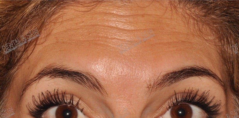 Before Treatment